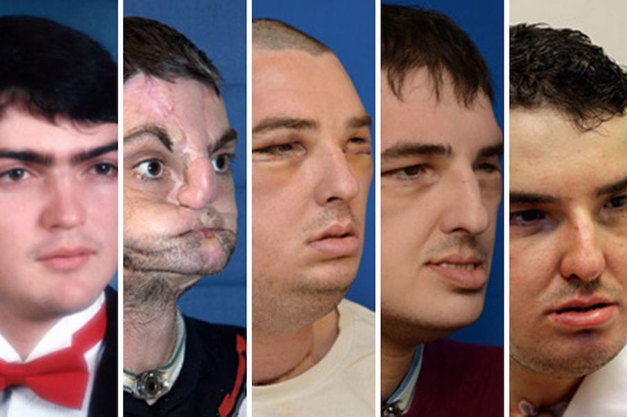 US firefighter gets world’s most extensive face transplant: Other cases of unusual body part transplants