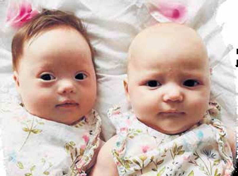 Wanita lahirkan kembar normal, sindrom Down